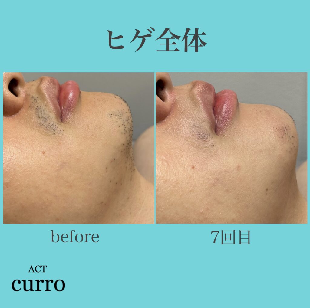 横浜日吉脱毛サロン