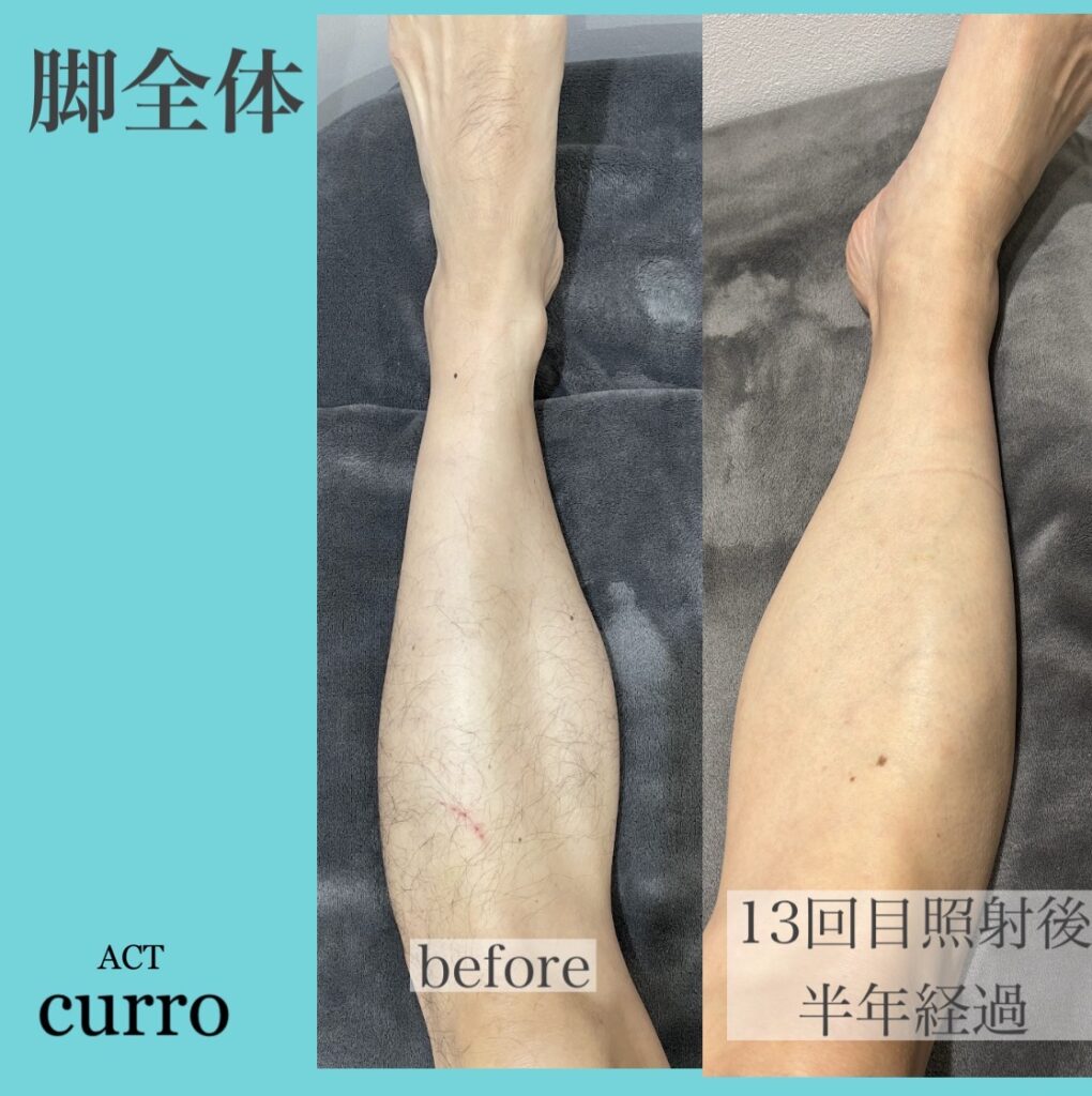 横浜日吉脱毛サロン