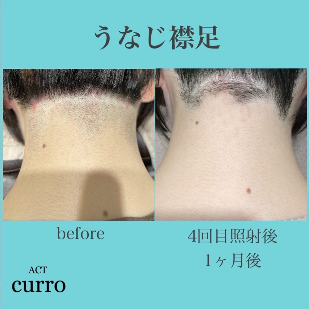 横浜日吉脱毛サロン