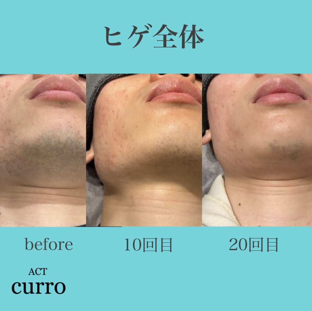 横浜日吉脱毛サロン