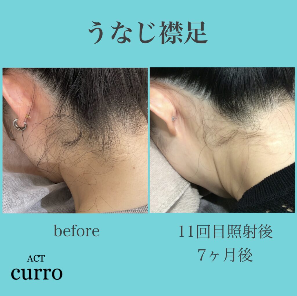 横浜日吉脱毛サロン
